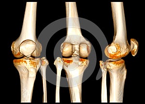 CT Scan of  Knee joint 3D rendering Showing fracture of Patella