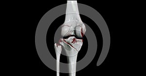 CT Scan of Knee joint showing fracture tibia and fibula bone 3D rendering