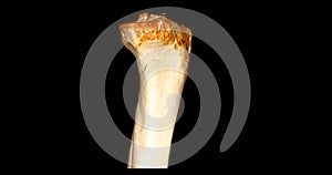CT Scan of Knee joint showing fracture tibia and fibula bone 3D rendering