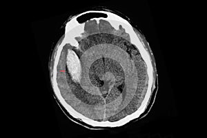 CT scan of a large intracerebral hemorrhge of the brain