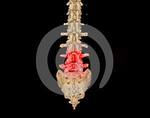 CT scan of Lumbar spine  3D rendering showing Profile Human Spine