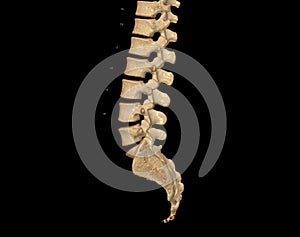 CT scan of Lumbar spine  3D rendering showing Profile Human Spine