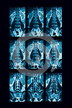 CT-scan of lumbar spine, case of lumbar spondylosis