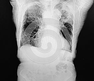 Ct scan lung cavitary mass malignancy