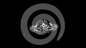 CT scan of a male patient with right cervical non-Hodgkin`s lymphoma