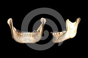 CT SCAN of Mandible bone.