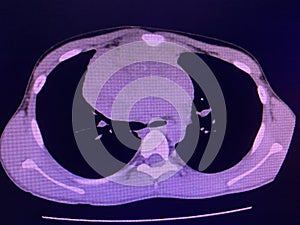 CT scan mass at interior mediastinum