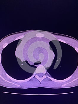 CT scan mass at interior mediastinum