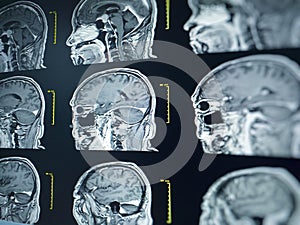 CT scan and MRI of brain : show cerebral infarct , intracerebral hemorrhage