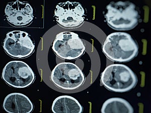 CT scan and MRI of brain : show cerebral infarct , intracerebral hemorrhage