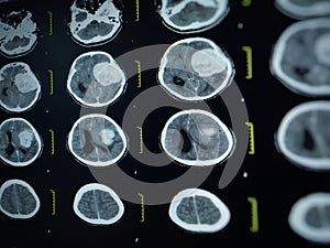 CT scan and MRI of brain : show cerebral infarct , intracerebral hemorrhage