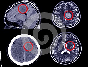 CT Scan of Brain showing Intracerebral Haemorrhage - Axial View photo