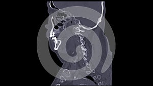 A CT scan of the neck sagittal view for diagnostic technique is essential for evaluating cervical vertebrae, soft tissues, and