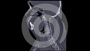 A CT scan of the neck sagittal view for diagnostic technique is essential for evaluating cervical vertebrae, soft tissues, and