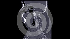 A CT scan of the neck sagittal view for diagnostic technique is essential for evaluating cervical vertebrae, soft tissues, and