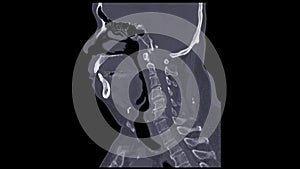 A CT scan of the neck sagittal view for diagnostic technique is essential for evaluating cervical vertebrae, soft tissues, and