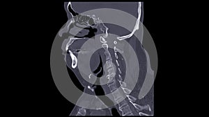 A CT scan of the neck sagittal view for diagnostic technique is essential for evaluating cervical vertebrae, soft tissues, and