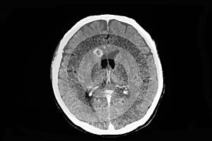CT scan of a patient with brain abscess photo