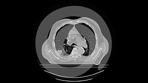 CT scan of a patient with a lung tumor