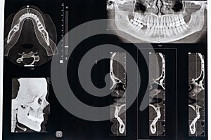 CT scan of a patient with malocclusion, missing chewing tooth and temporomandibular joint dysfunction.