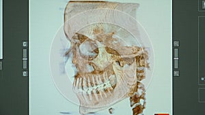 CT scan of a patient with malocclusion, missing tooth and temporomandibular joint dysfunction.