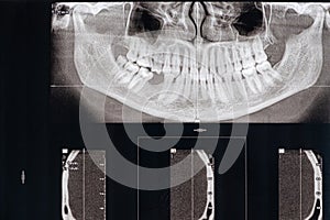 CT scan of a patient with missing chewing tooth and malocclusion