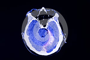 CT scan of a patient with traumatic brain injury