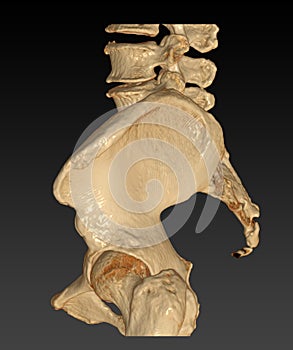 CT Scan of pelvic bone with both hip joint 3D rendering image Laterla view