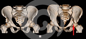 CT Scan pelvis Impression: - Transverse fracture of acetabulum. - Fracture Lt ishiopubic rami. - Posterosuperior dislocation of Lt photo