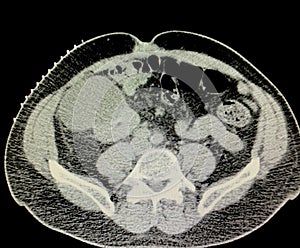 Ct scan right renal cyst  preoperative imaging