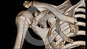 CT Scan shoulder. Fracture posterior half of glenoid with posterior dislocation of bone fragment. Irregular transverse fracture at