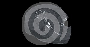 CT Scan of Shoulder joint in case  fracture shoulder joint