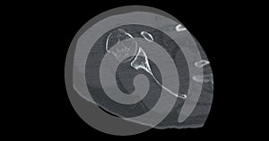 CT Scan of Shoulder joint in case  fracture shoulder joint