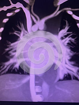 CT scan angiogram show dextrocardia the congenital heart disease photo
