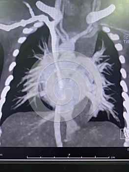 CT scan angiogram show dextrocardia the congenital heart disease photo