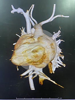 CT scan angiogram show dextrocardia the congenital heart disease photo