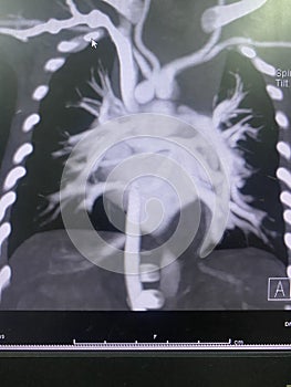 CT scan angiogram show dextrocardia the congenital heart disease photo