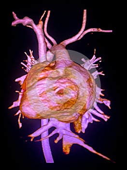 CT scan angiogram show dextrocardia the congenital heart disease photo