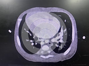 CT scan angiogram show dextrocardia the congenital heart disease photo