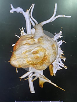 CT scan angiogram show dextrocardia the congenital heart disease photo
