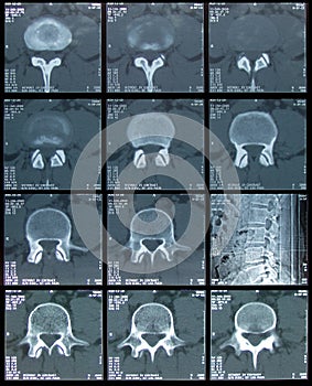 CT Scan of spine