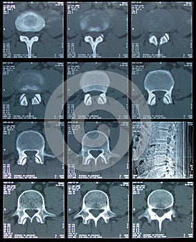 CT Scan of spine photo