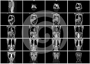 Ct scan step set of body coronal view