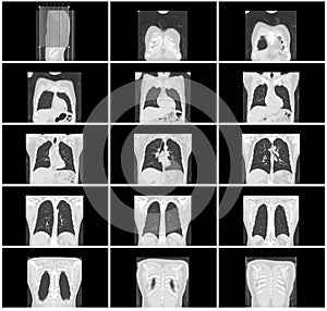 Ct scan step set of body lung coronal view