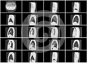 Ct scan step set of body lung sagittal view