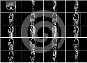 Ct scan step set of body sagittal view photo