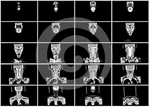 Ct scan step set of neck coronal view
