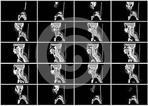 Ct scan step set of neck sagittal view