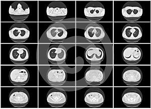 Ct scan step set of upper body lung axial top view