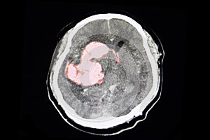 CT scan of stroke patient